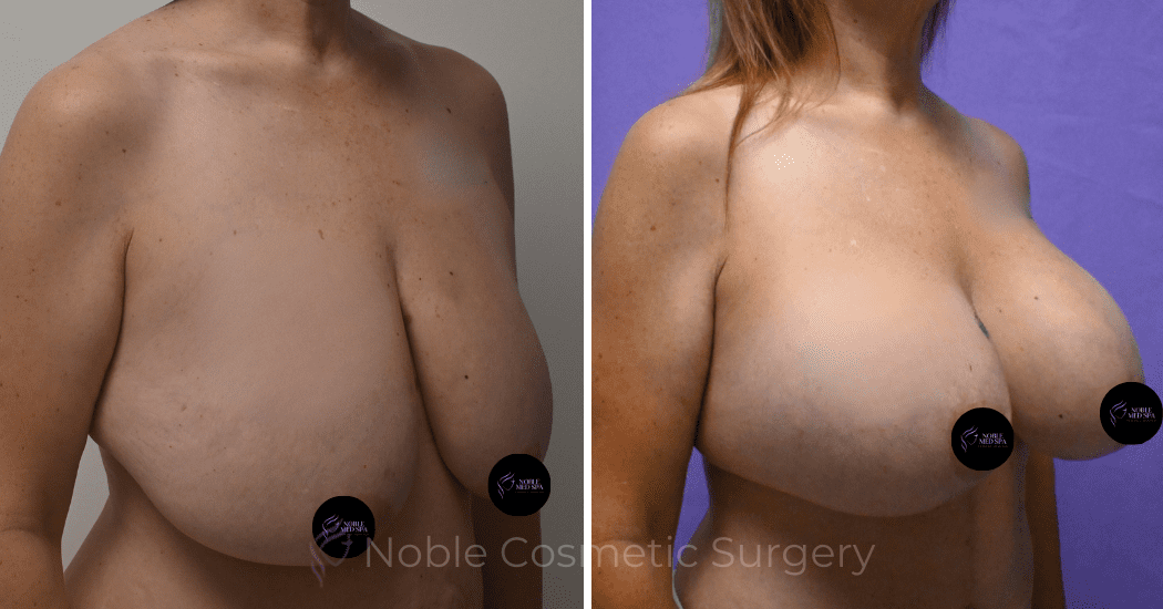 BREAST-AUGMENTATION-WITH-LIFT-CASE-10275 | Before and After Breast Augmentation with Lift 2