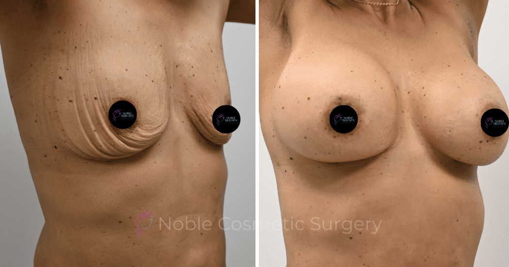 BREAST-AUGMENTATION-CASE-13021 | Before and After Breast Augmentation 2