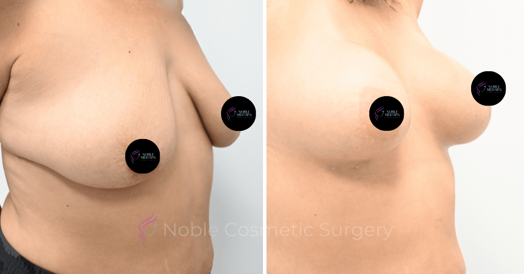 BREAST-AUGMENTATION-CASE-12478 | Before and After Breast Augmentation