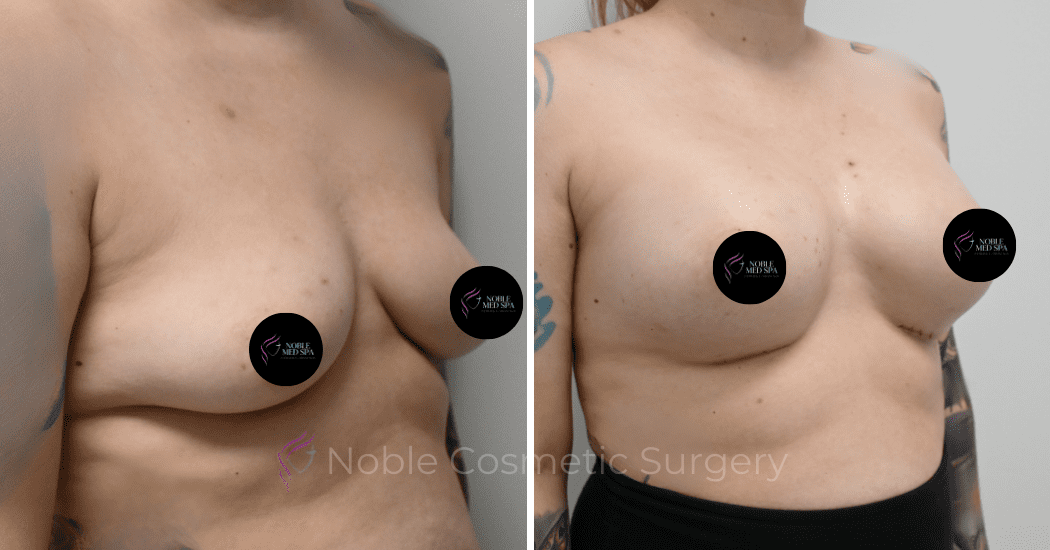 BREAST-AUGMENTATION-CASE-11771 | Before and After Breast Augmentation 3