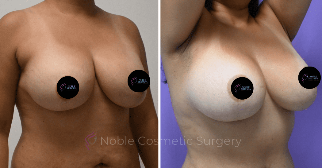 BREAST-AUGMENTATION--CASE-00310 | Before and After Breast Augmentation 2
