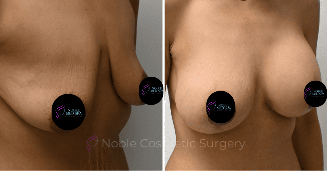 BREAST-AUGMENTATION-WITH-LIFT-CASE-10931 | Before and After Breast Augmentation with Lift 2