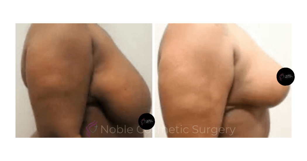 BREAST-REDUCTION-CASE-18364 | Before and After Breast Reduction 2