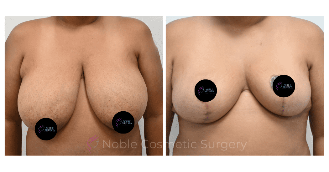 BREAST-REDUCTION-CASE-00803 | Before and After Breast Reduction