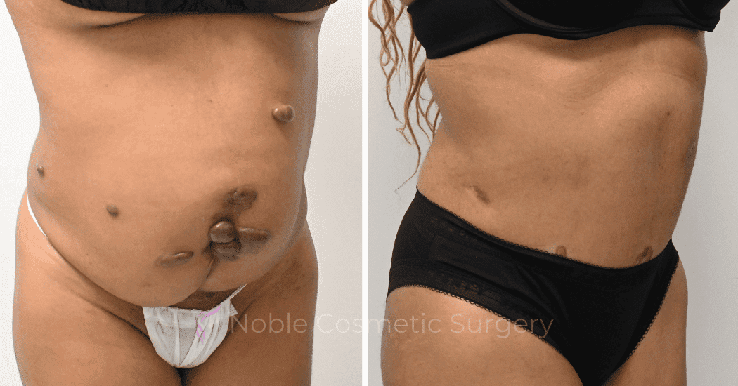 TUMMY-TUCK-CASE-10972 | Before and After Abdominoplasty 2