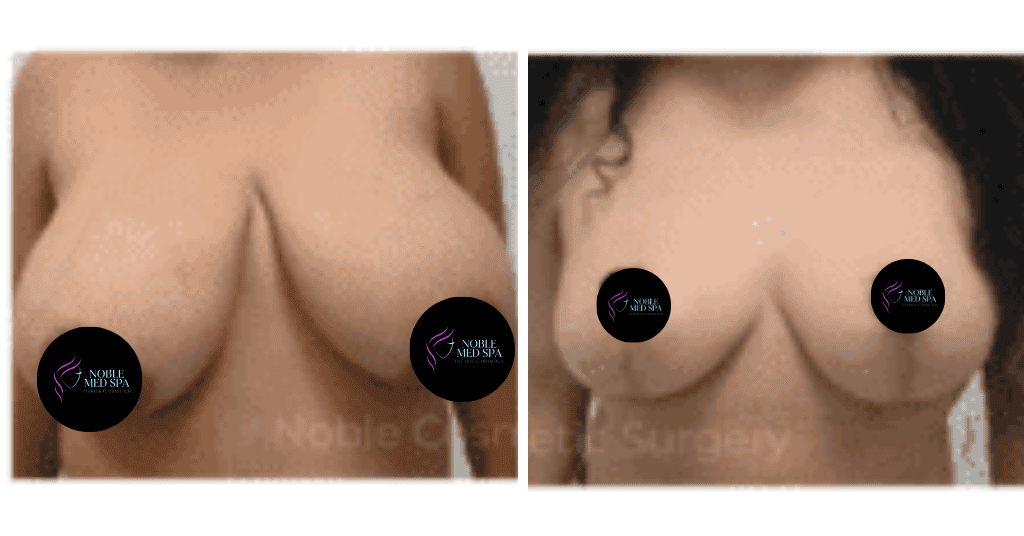 BREAST-REDUCTION-CASE-19221 | Before and After Breast Reduction