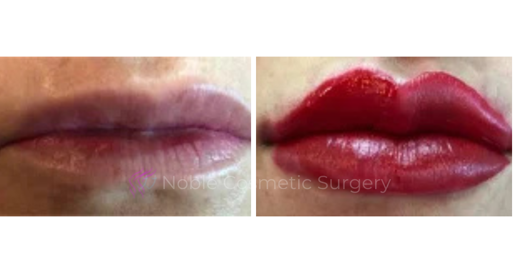 DERMAL-FILLERS-CASE-00258 | Before and After Dermal Fillers 2