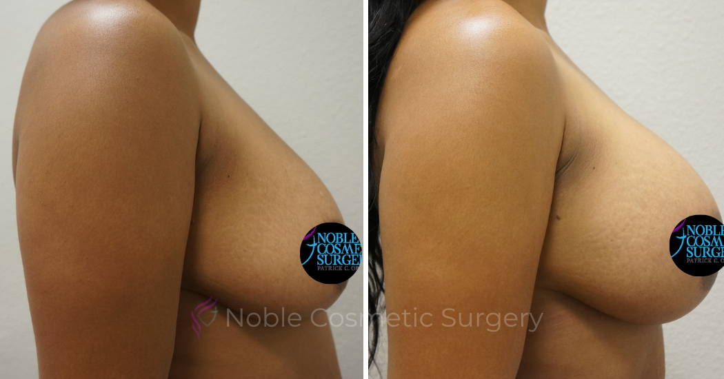 BREAST-AUGMENTATION--WITH-FAT-TRANSFER--CASE-00268 | Before and After Breast Augmentation 2
