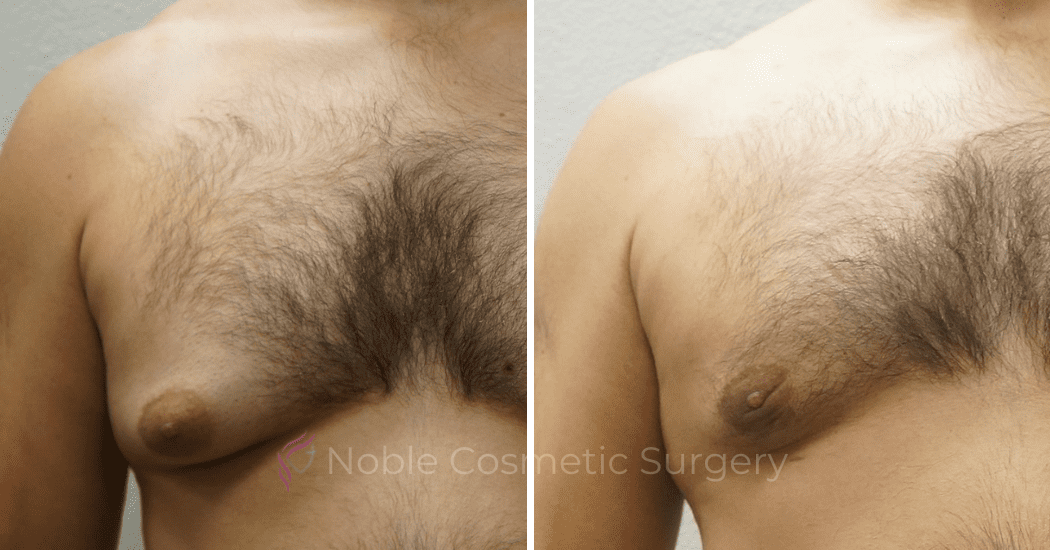 GYNECOMASTIA--CASE-16730 | Before and After Gynecomastia 2