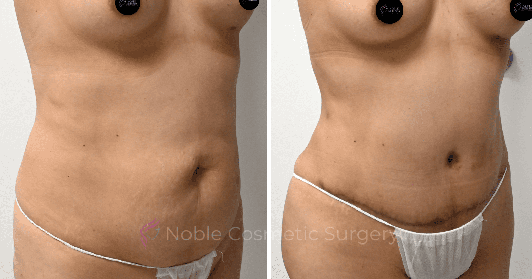 TUMMY-TUCK-CASE-00313 | Before and After Abdominoplasty 2