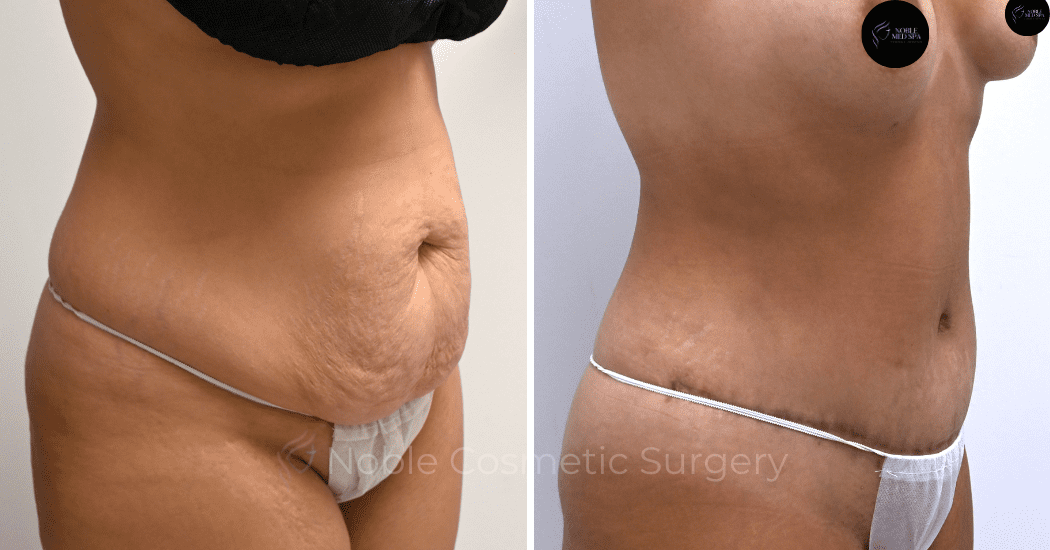 TUMMY-TUCK-CASE-00316 | Before and After Abdominoplasty 2
