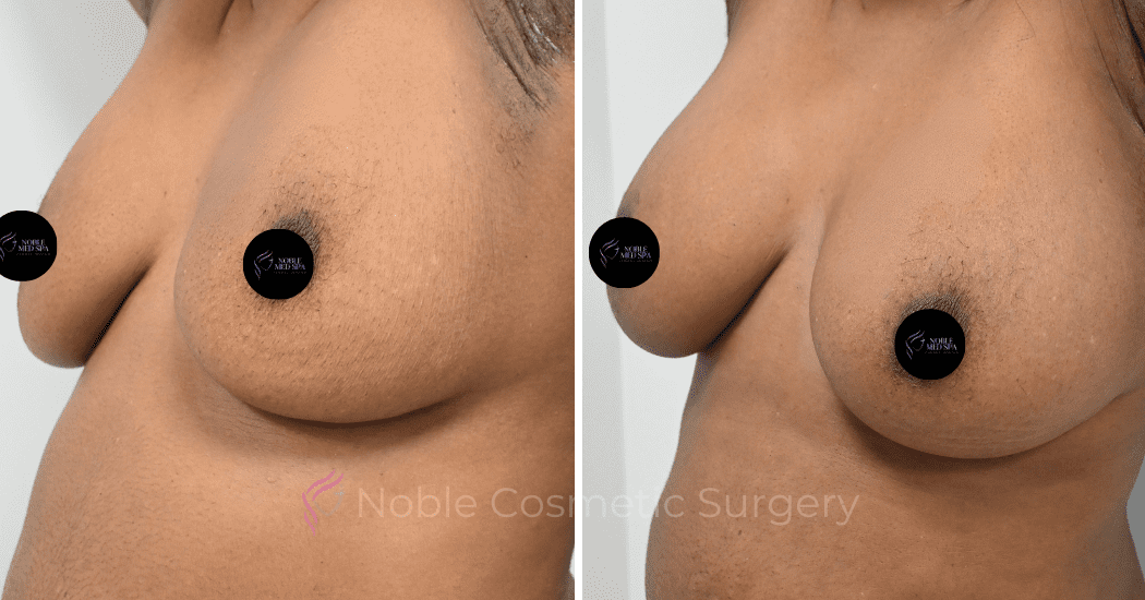 BREAST-AUGMENTATION-WITH-FAT-TRANSFER-CASE-00261 | Before and After Breast Augmentation 2