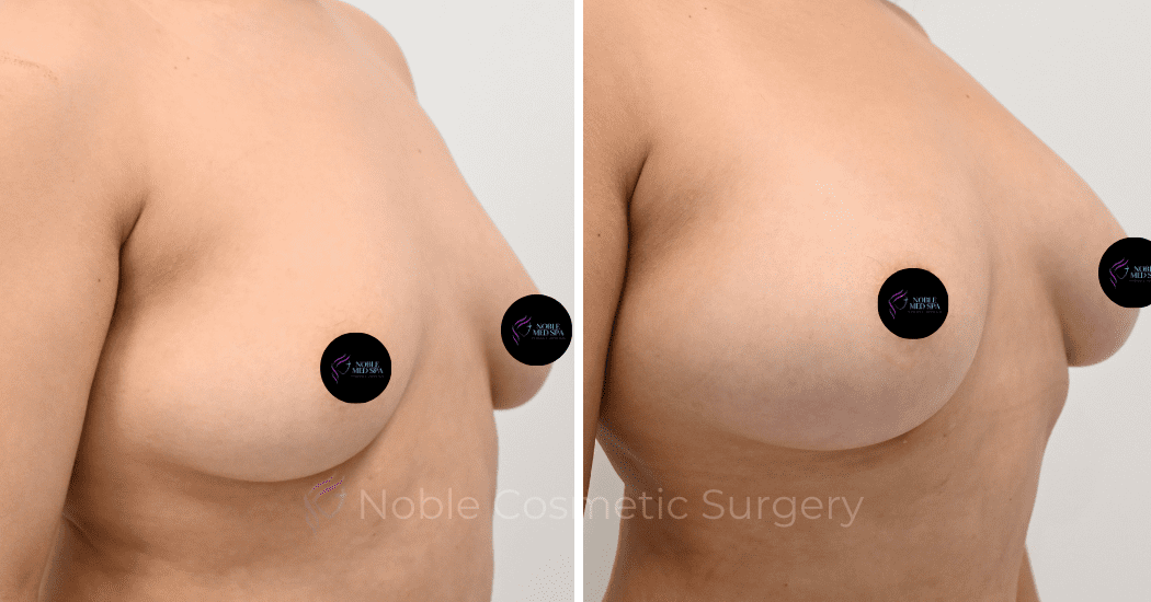 BREAST-AUGUMENTATION-WITH-FAT-TRANSFER-CASE-16210 | Before and After Breast Augmentation 2