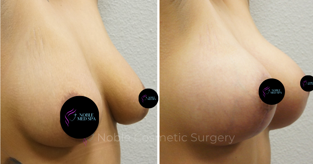 BREAST-AUGMENTATION--WITH-LIFT--CASE-00309 | Before and After Breast Augmentation with Lift 2