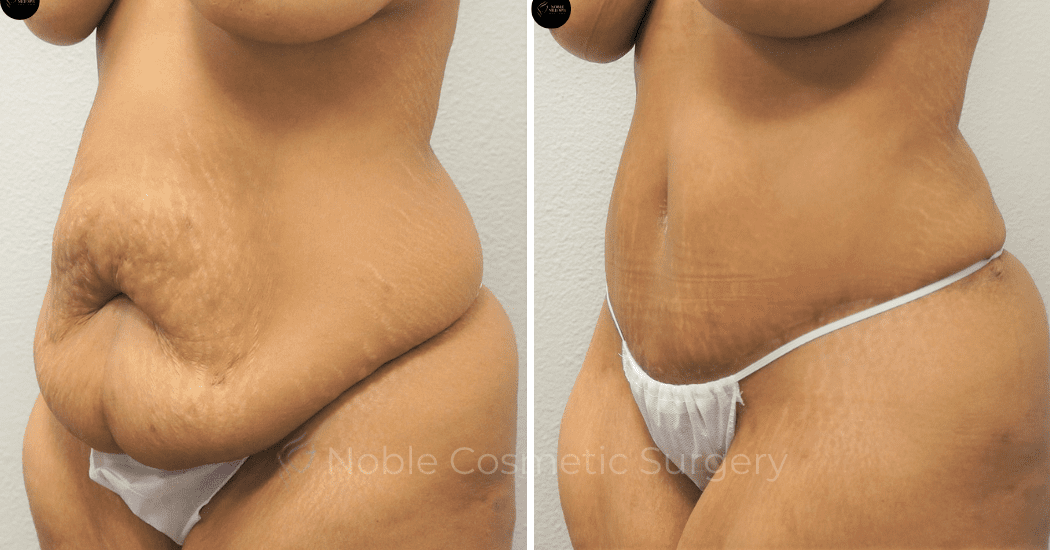 TUMMY-TUCK-CASE-00301 | Before and After Abdominoplasty 2