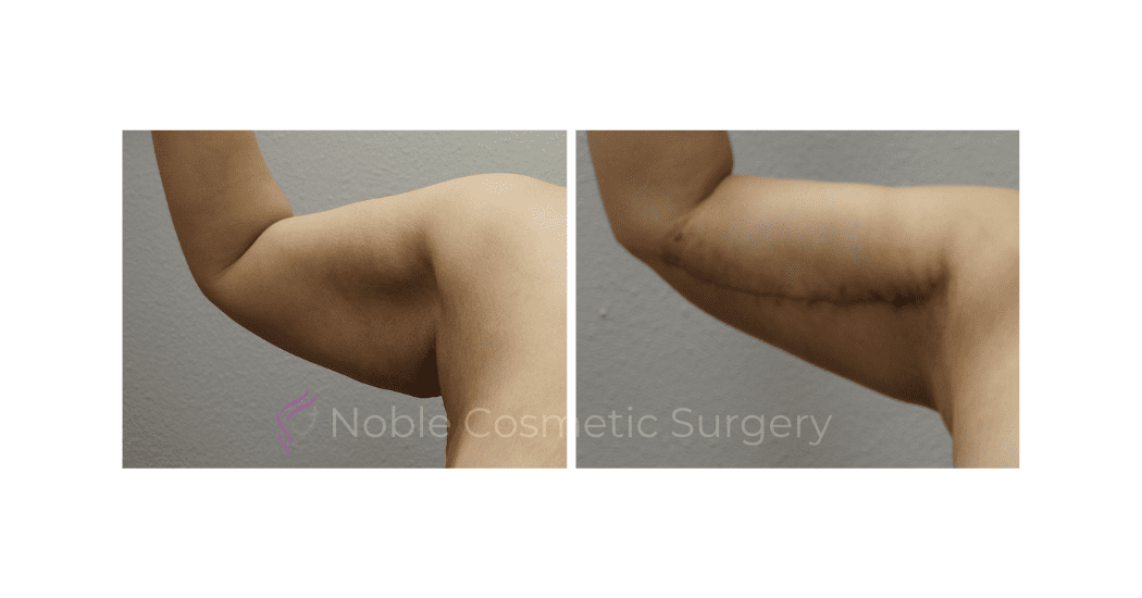 ARM-LIFT-CASE-17203 | Before and After Brachioplasty 2