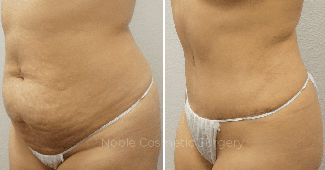TUMMY-TUCK-CASE-00304 | Before and After Abdominoplasty 2