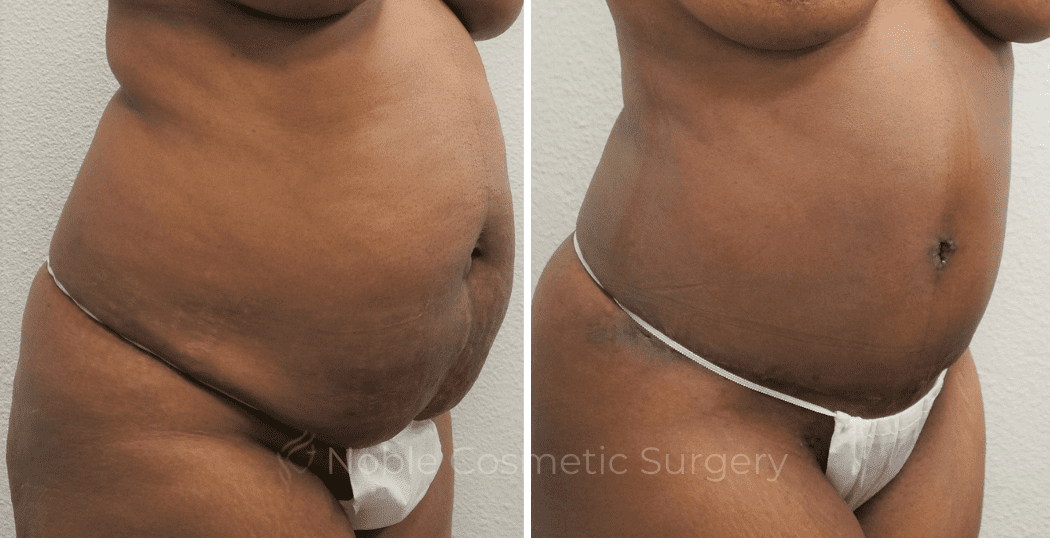 TUMMY-TUCK-CASE-00306 | Before and After Abdominoplasty 2