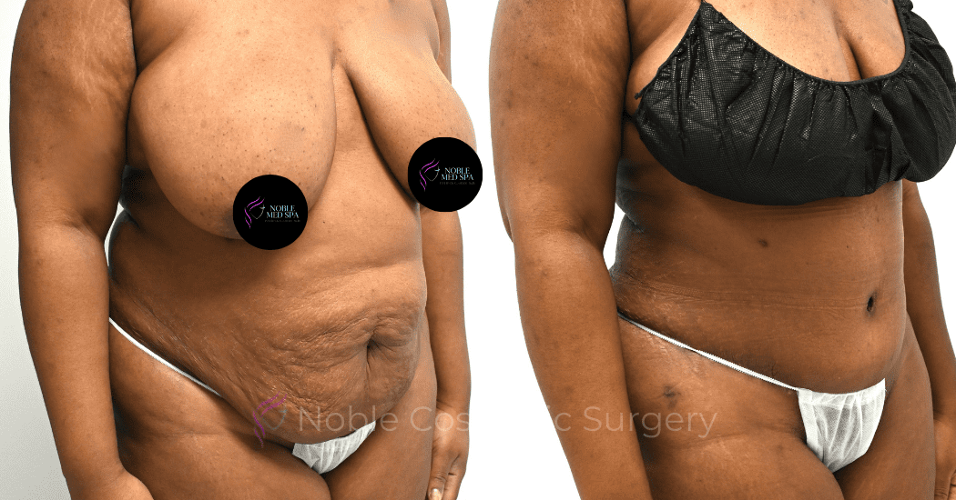 TUMMY-TUCK-CASE-00308 | Before and After Abdominoplasty 2