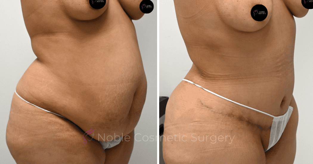 TUMMY-TUCK-CASE-00310 | Before and After Abdominoplasty 2