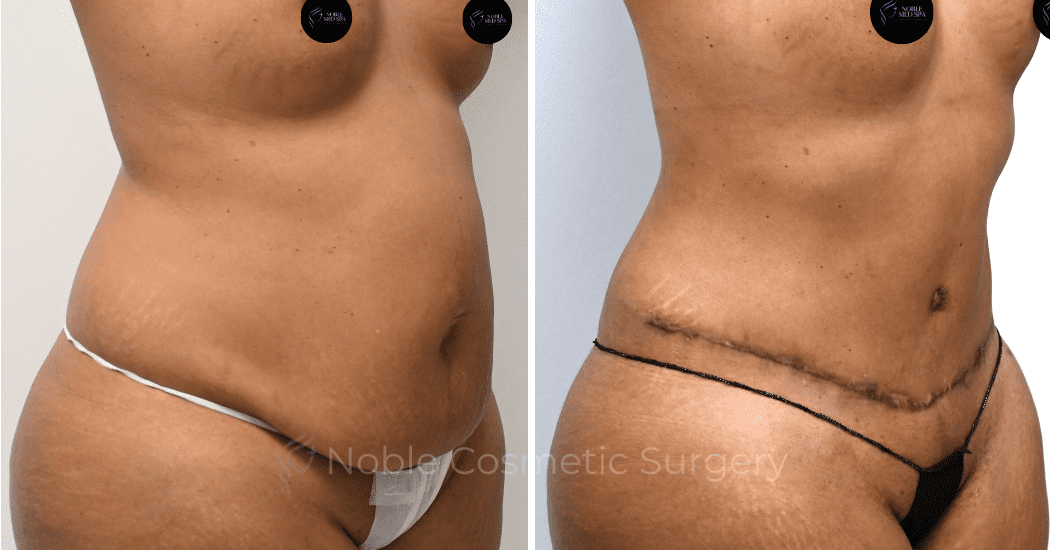 TUMMY-TUCK-CASE-00312 | Before and After Abdominoplasty 2