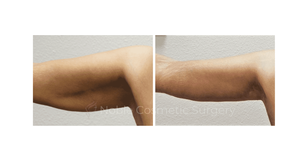 ARM-LIFT-CASE-00253 | Before and After Brachioplasty 2