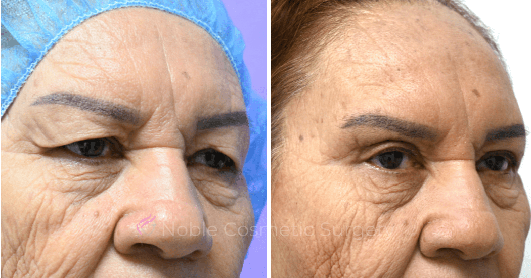 BLEPHAROPLASTY-CASE-10180 | Before and After Blepharoplasty 2
