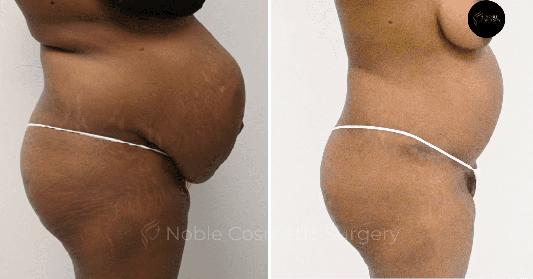TUMMY-TUCK-CASE-11379 | Before and After Abdominoplasty 2