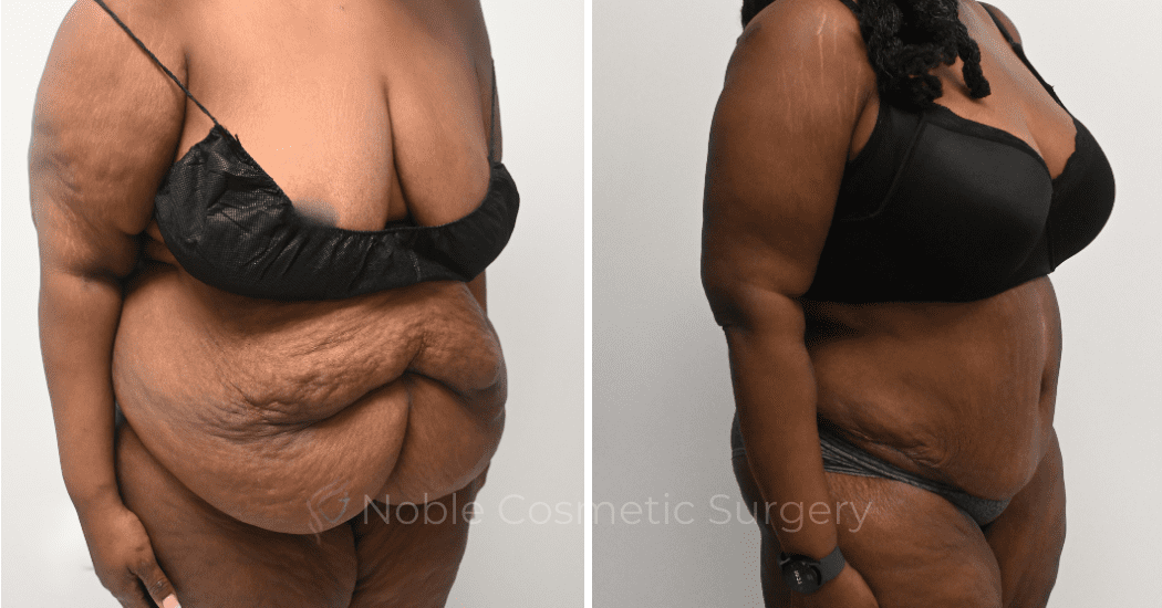 TUMMY-TUCK-CASE-00321 | Before and After Abdominoplasty 2