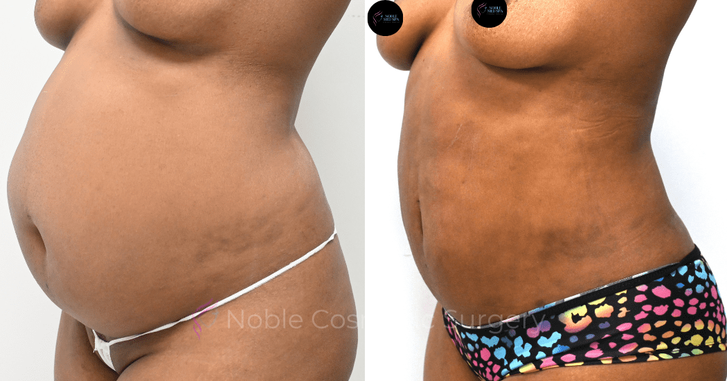 TUMMY-TUCK-CASE-00311 | Before and After Abdominoplasty 2