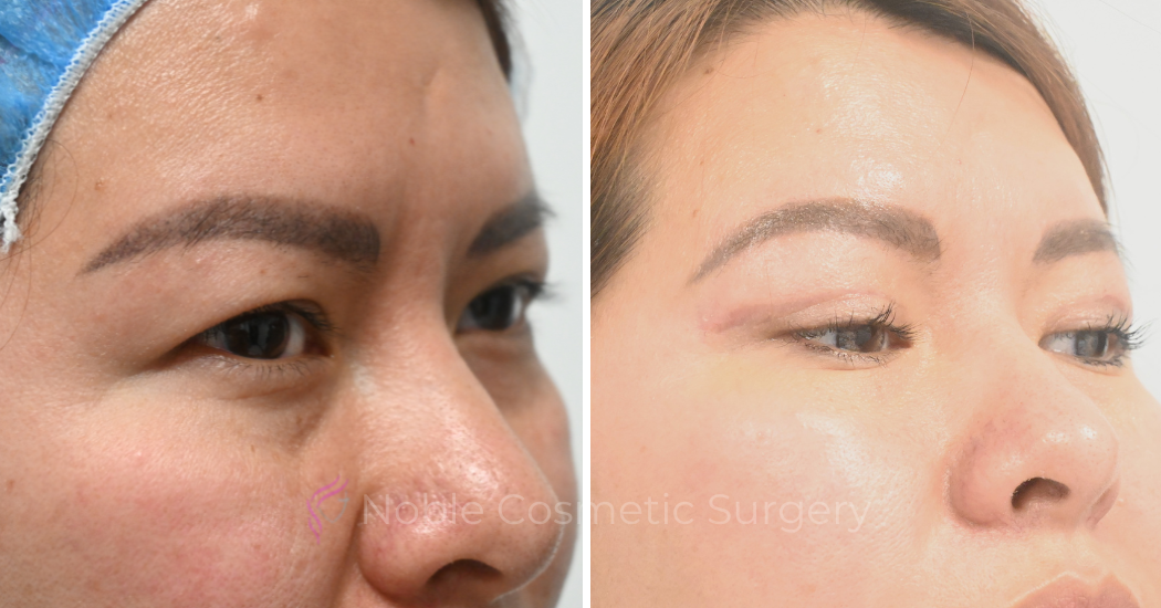 BLEPHAROPLASTY-CASE-10083 | Before and After Blepharoplasty 2