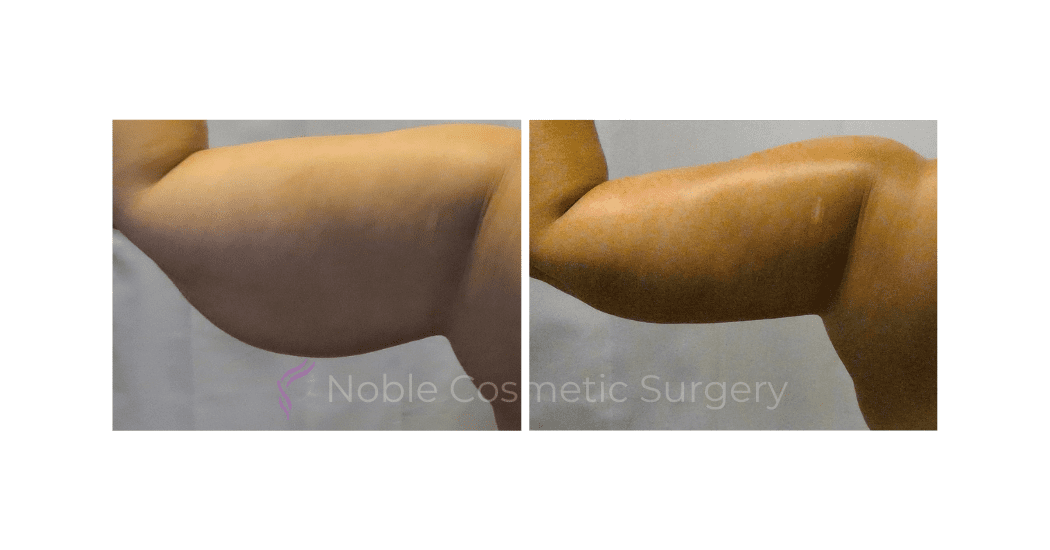 ARM-LIFT-CASE-19050 | Before and After Brachioplasty 2