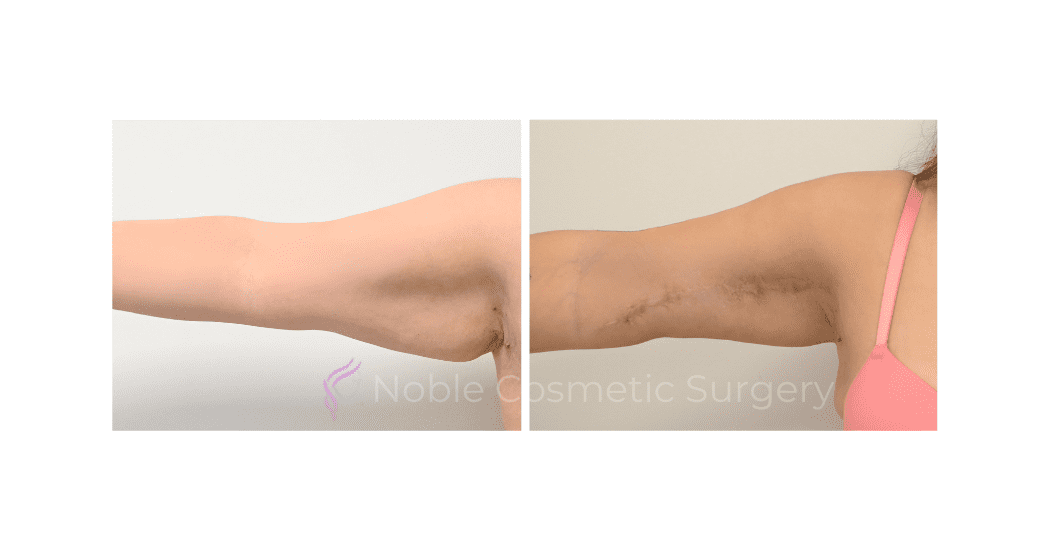 ARM-LIFT-CASE-15380 | Before and After Brachioplasty 2