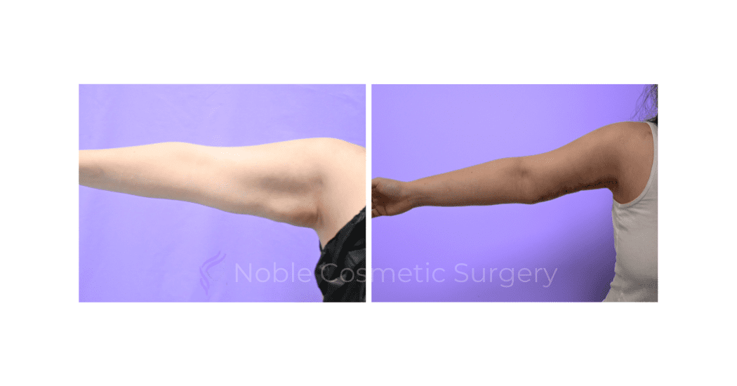 ARM-LIFT-CASE-19182 | Before and After Brachioplasty 2