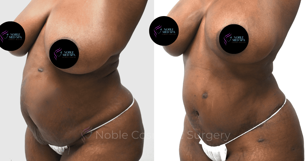 TUMMY-TUCK-CASE-00300 | Before and After Abdominoplasty 2