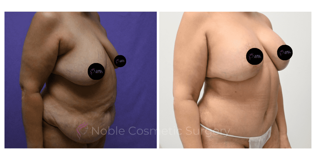 BREAST-REDUCTION-CASE-00220 | Before and After Breast Reduction 2