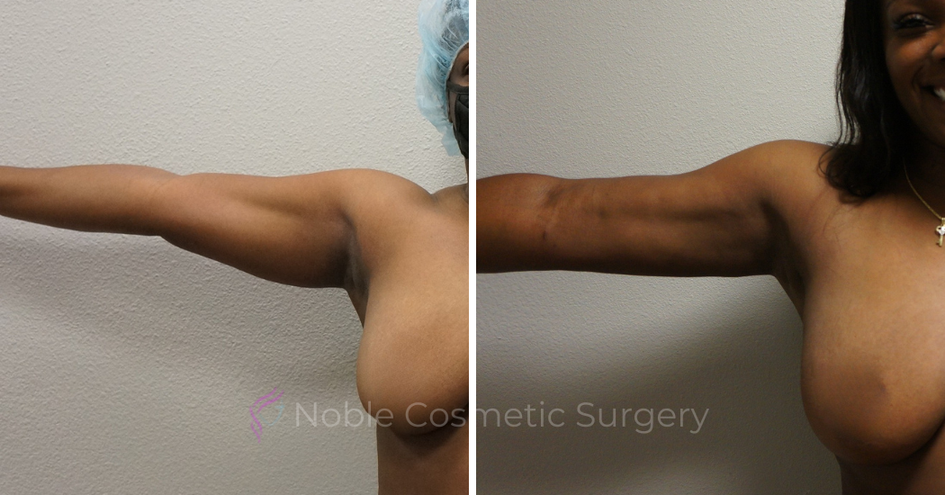 LIPOSUCTION-ARMS-CASE-00500 | Before and After Arm Liposuction 2