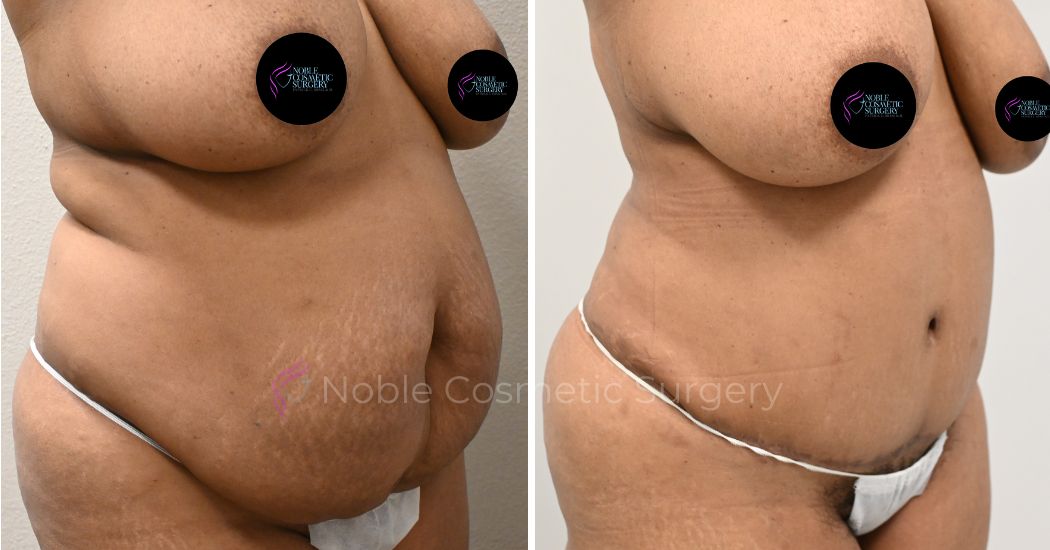 TUMMY-TUCK-CASE-00031 | Before and After Abdominoplasty 2