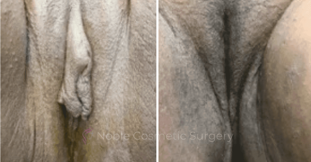 Labiaplasty-Case-20266 | Before and After Labiaplasty