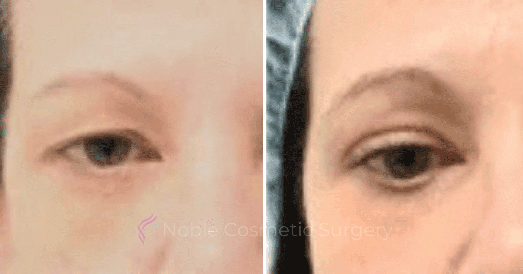 BLEPHAROPLASTY-CASE-20259 | Before and After Blepharoplasty