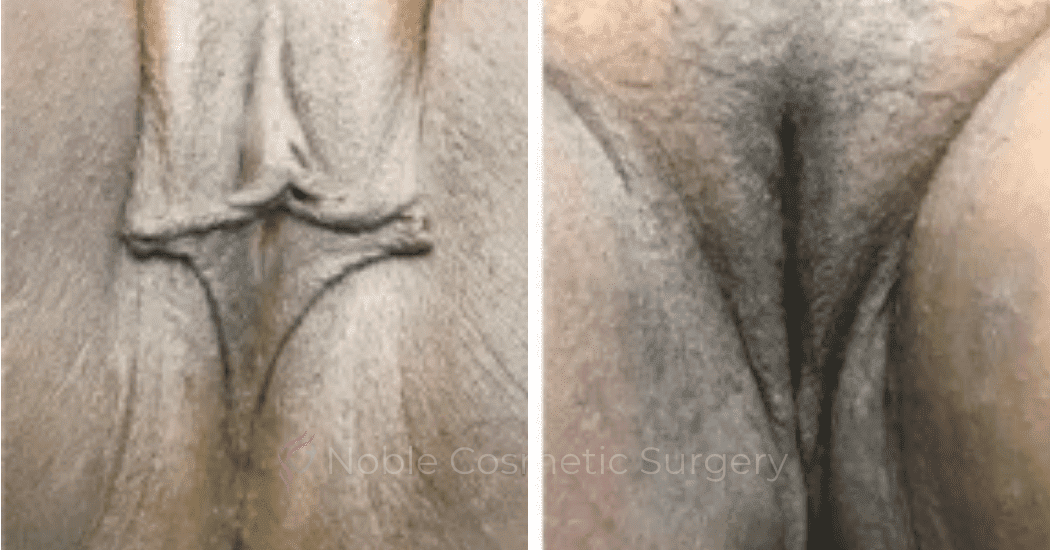 Labiaplasty-Case-20265 | Before and After Labiaplasty