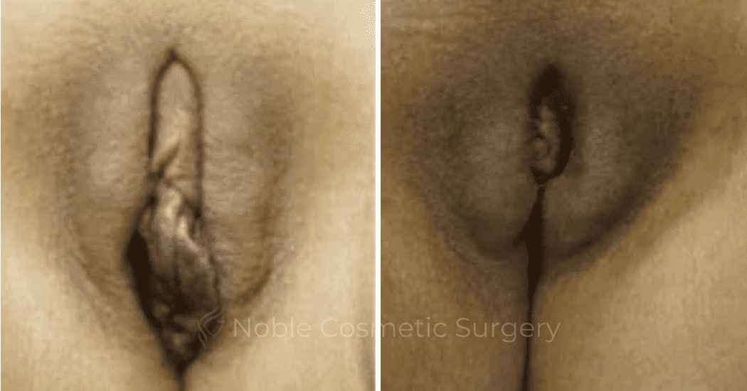 Labiaplasty-Case-20264 | Before and After Labiaplasty