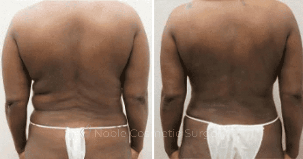 Back-Lift-Case-00254 | Before and After Back Lift