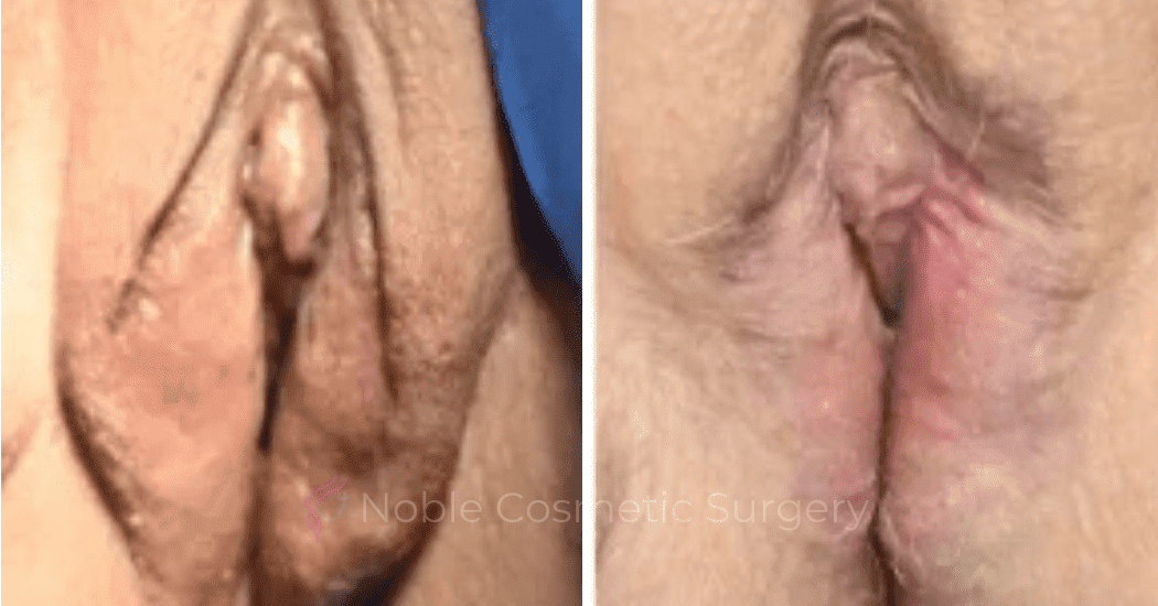 Labiaplasty-Case-20263 | Before and After Labiaplasty
