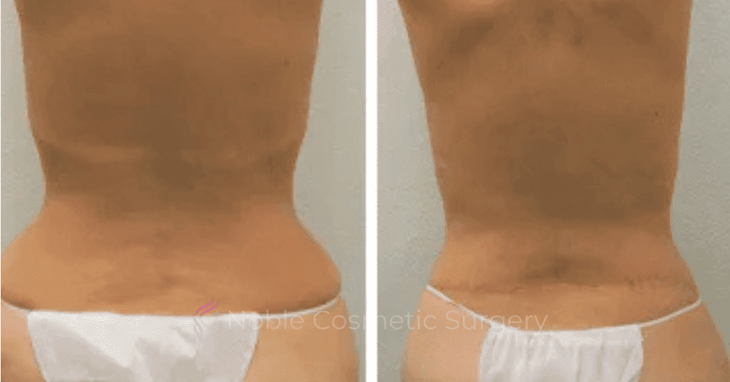 BACK-LIFT-CASE-00255 | Before and After Back Lift
