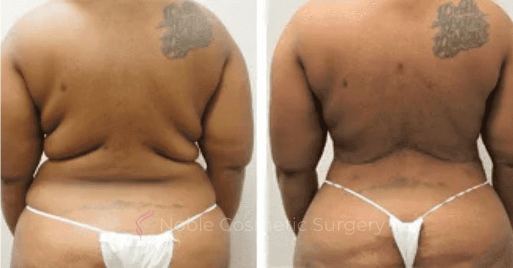 BACK-LIFT-CASE-00256 | Before and After Back Lift