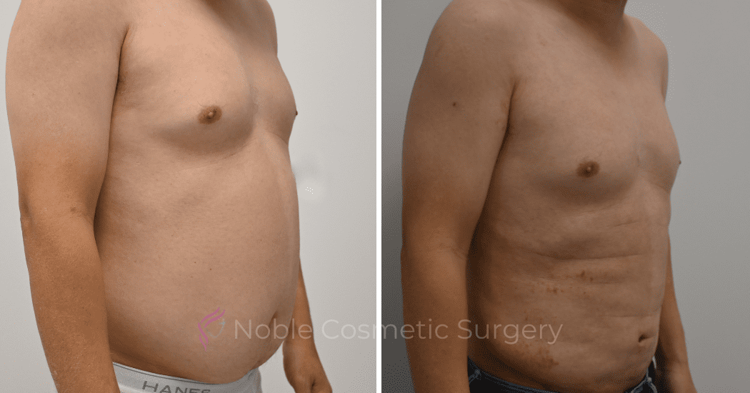 LIPOSUCTION-ABDOMEN-CASE-12252 | Before and After Male Liposuction 2