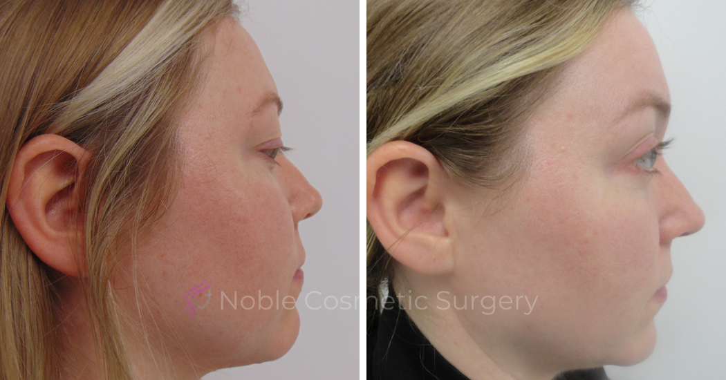 PICO-LASER-CASE-00005 | Before and After Pico Skin Rejuvenation 2