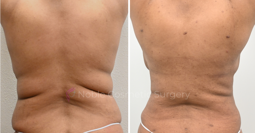 TUMMY-TUCK-CASE-00035 | Before and After Abdominoplasty 3