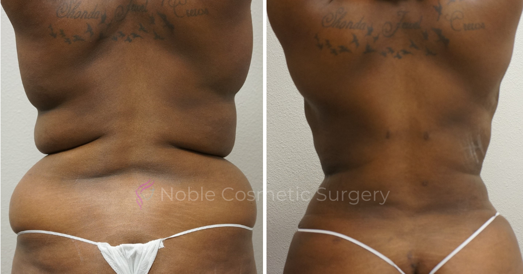 TUMMY-TUCK-CASE-00042 | Before and After Abdominoplasty 3
